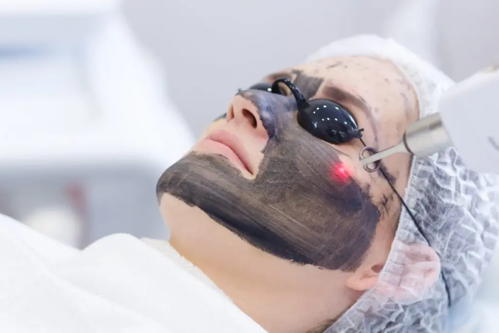 Woman Receiving Carbon Laser Facial at B Beautiful Med Spa