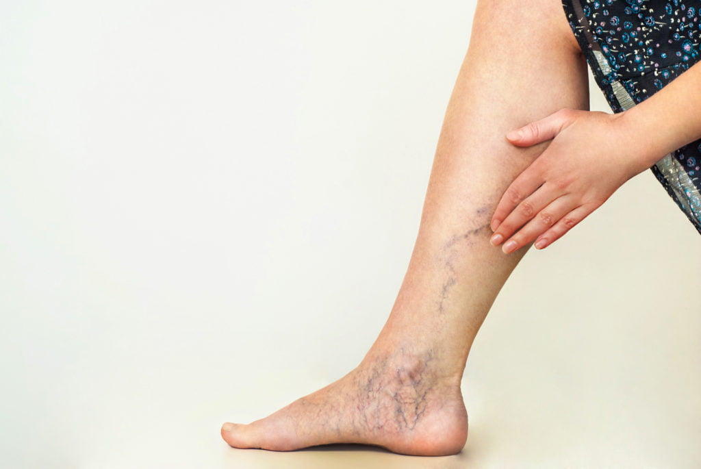 What Causes Varicose or Spider Veins