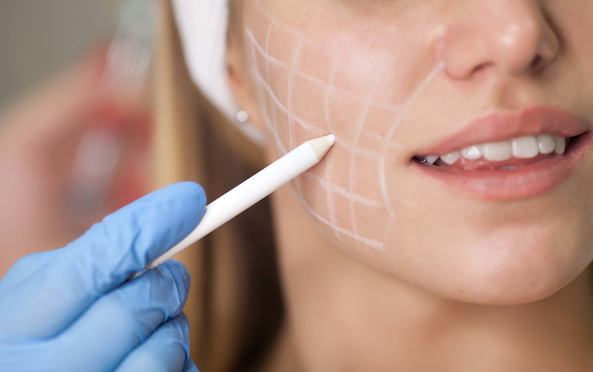 What Does A Carbon Laser Facial Do?