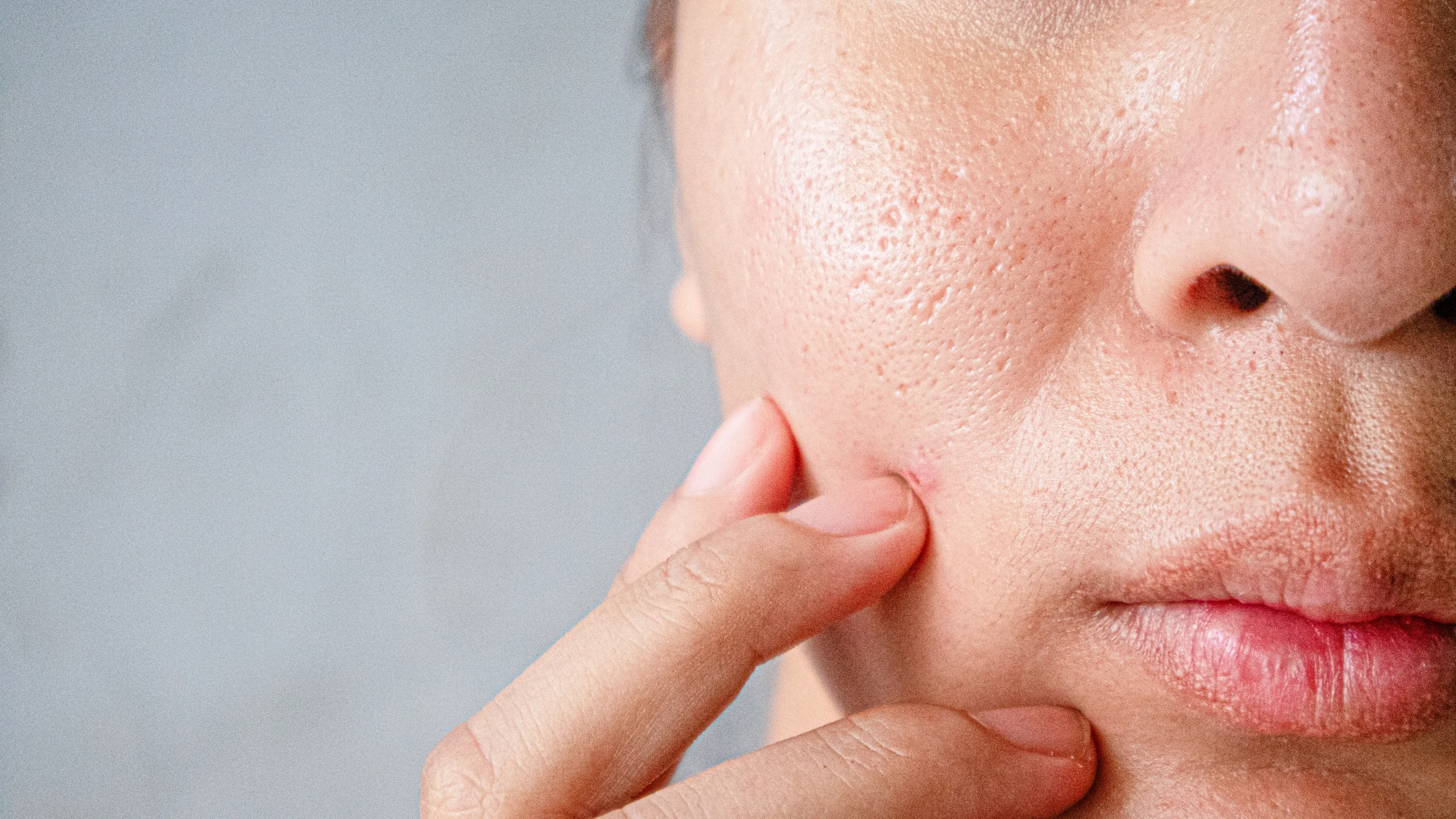 Chemical peels |B Beautiful Med Spa in Laguna Hills CA