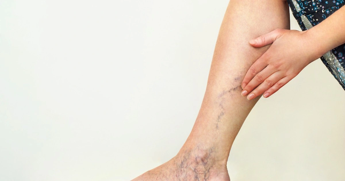 Man having Spider Veins on his legs in Laguna Hills, CA