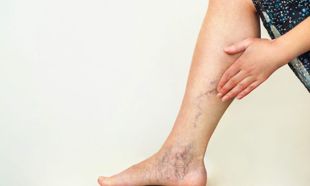 What Causes Varicose or Spider Veins